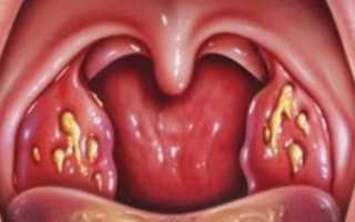 Язвенно-пленчатая ангина — симптомы, лечение и диагностика