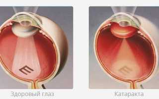 Диабетическая катаракта: симптомы, лечение и профилактика