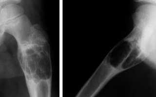 Аневризматическая костная киста: основная информация, симптоматика, лечение