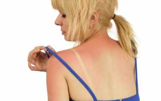 Аллергия на яркий солнечный свет — симптомы и причины возникновения болезни