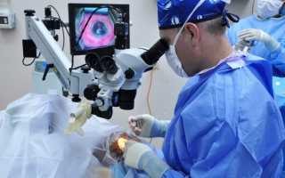 Замена хрусталика глаза при катаракте: подготовка к операции, показания и противопоказания