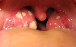 Тонзиллит и фарингит – симптомы и лечение заболеваний